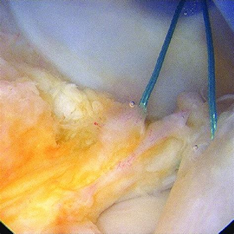 Arthroscopic View Showing Suture Repair Of Ramp Lesion Of Posteromedial Download Scientific
