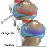Images of Bilateral Partial Knee Replacement Recovery Time