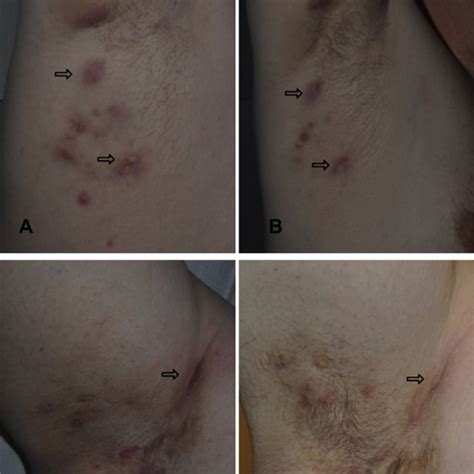 Modified Hidradenitis Suppurativa Score Mhss And Dermatology Life
