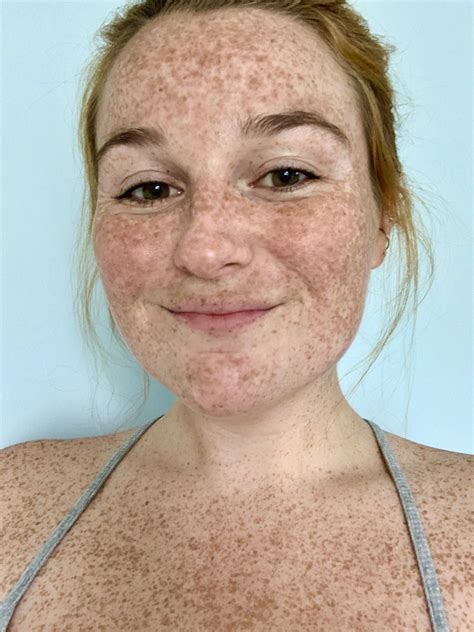 i went to the beach and got lots of new freckles r freckledgirls