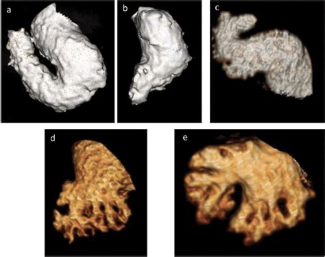 Different Morphologies Of The Left Atrial Appendage As Seen On 3d Ct