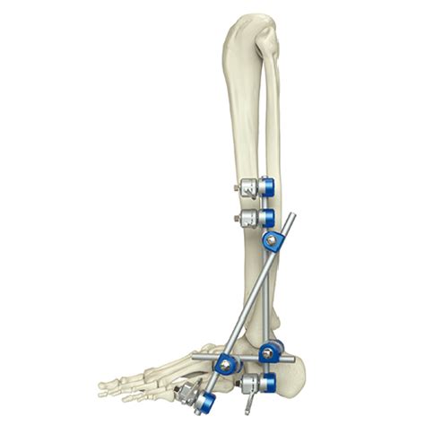 Ankle Joint External Fixator Orthopedic Drills And Medical Devices