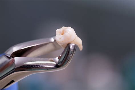 Wisdom Tooth Extraction And Dry Sockets