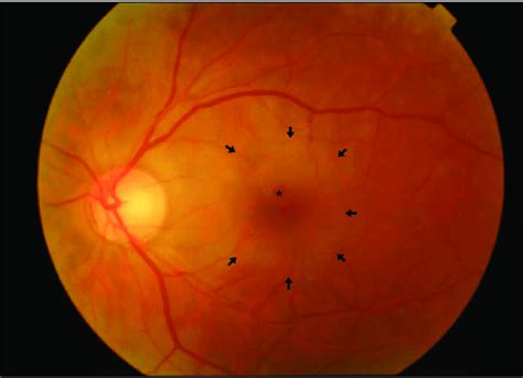 So what are those little red spots anyway? A postoperative retinal fundoscopy shows cherry-red spot ...