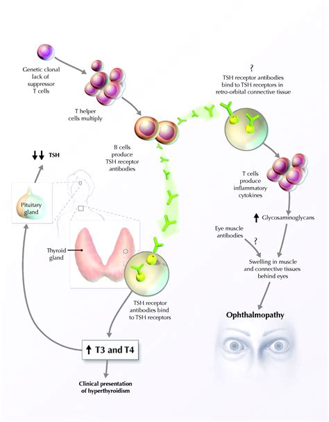 Diagnosis And Management Of Graves Disease Cmaj