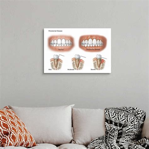 Three Stages Of Periodontal Disease Wall Art Canvas Prints Framed