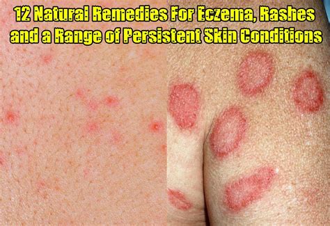 12 Natural Remedies For Eczema Rashes And A Range Of Persistent Skin