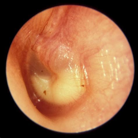 Perforated Eardrum Ruptured Eardrum Symptoms Treatment Surgery