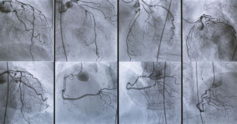 Coronary Angiography Procedure Side Effects And Faqs