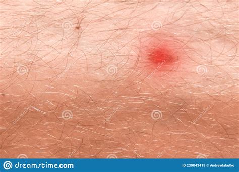 Red Wound On The Skin Of A Man`s Hairy Leg Close Up Stock Image