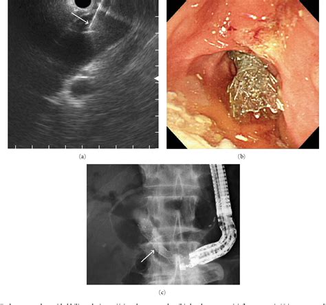 Figure From Endosonography Guided Biliary Drainage With One Step