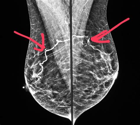 Mammogram Shows Artery Calcifications Although Benign It Is