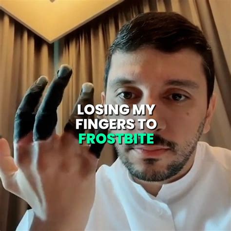 Lost My Fingers To Frostbite Finger Man What An Incredibly Brave