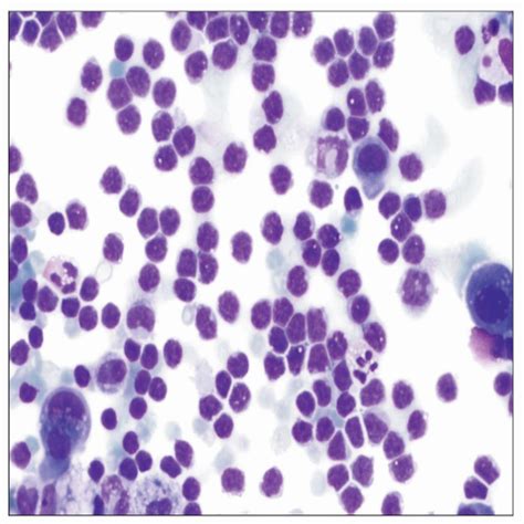 Lymphoma Cells Pleural Fluid