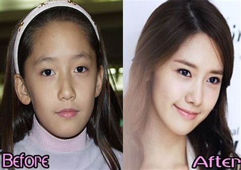 Im Yoon Ah Plastic Surgery Snsd Yoona Before And After Plastic Surgery Pictures Snsd Plastic