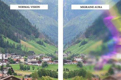Differences Between Normal Vision And Vision With Migraine Aura