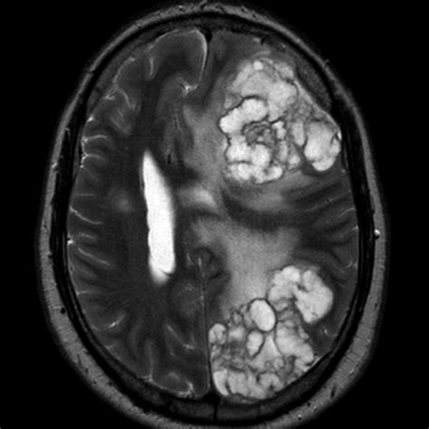 Cerebral Cryptococcosis Image