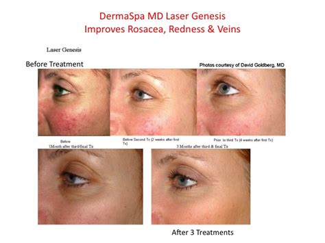 Rosacea Redness And Facial Veins