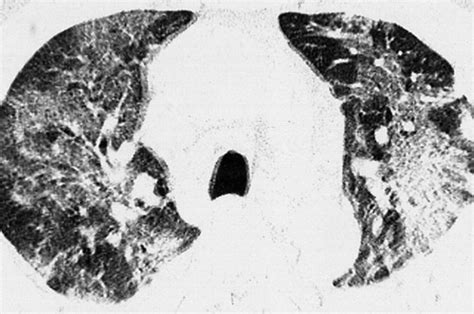 Eosinophilic Lung Diseases A Clinical Radiologic And Pathologic