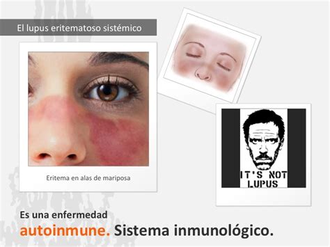 Lupus Y Género Médico Internista Medicina Interna