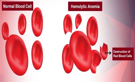 Hemolytic Anemia Causes Symptoms And Treatment