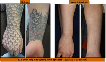Undo ® was developed and tested by veteran permanent makeup and tattoo artists for a need to provide their clients with safe and effective ink and pigment removal. Laser Tattoo Removal Training - IAPAM Aesthetic Medicine ...