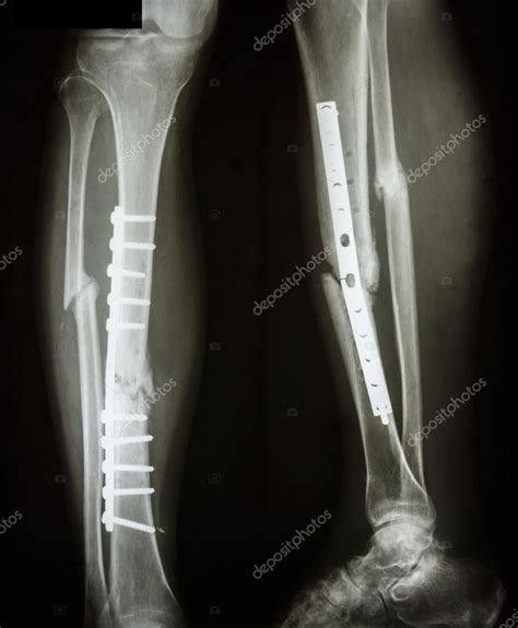 Fracture Shaft Of Tibia And Fibula — Stock Photo © Stockdevil666 61193055