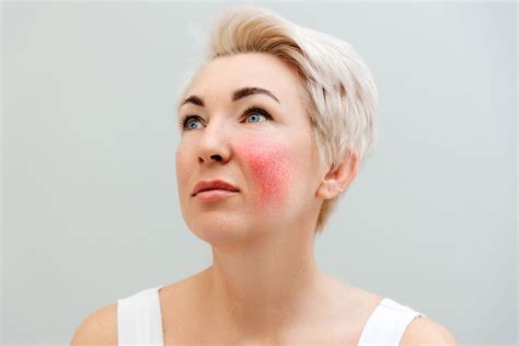 Rosacea Warning Signs What To Look Out For