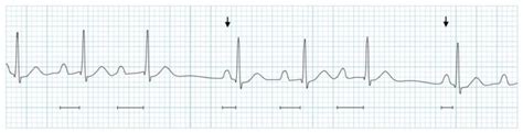 Av Block 2nd Degree Mobitz I Wenckebach Phenomenon Litfl