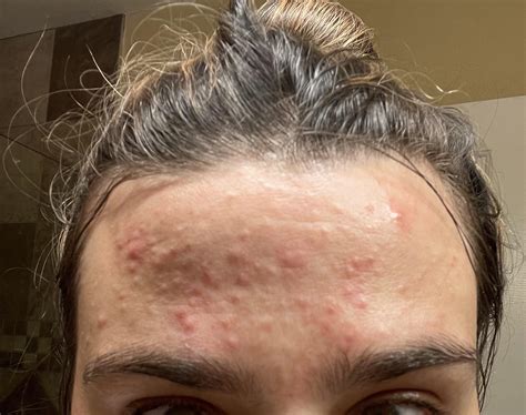 Acne Out Of Nowhere My Forehead Erupted In These Tiny Hard Red Bumps They Are Much Worse At