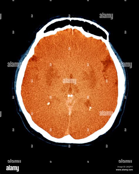 Coloured Computed Tomography Ct Scan In Axial Section Of The Brain Of