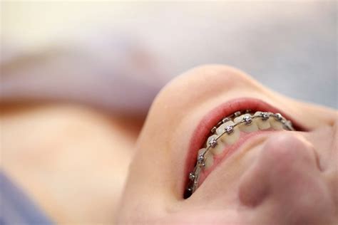 Lingual Braces In Richardson Tx Pros Cons Cost