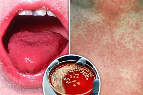 Scarlet Fever Rash How Do You Catch It Symptoms Of The Infection As