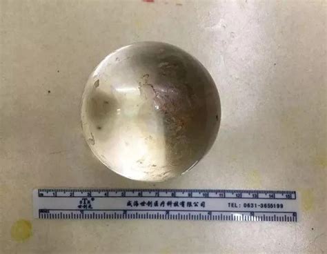 Man 31 Gets THREE INCH Wide Glass Ball Stuck In His Rectum After