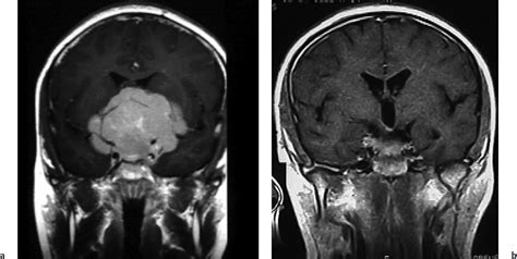 Skull Base Meningiomas And Other Tumors Oncohema Key