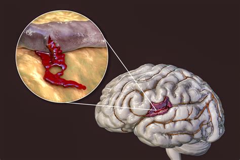 Understanding Brain Bleed And Hemorrhage Injury Cases In Personal
