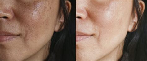 What Causes Hyperpigmentation And What Are The Best Treatments To