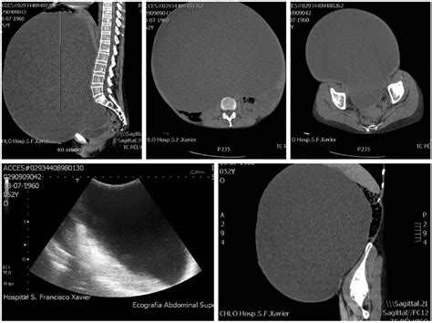 A Giant Intra Abdominal Cyst Bmj Case Reports