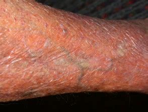 N engl j med 1999; Systemic corticosteroid | DermNet NZ