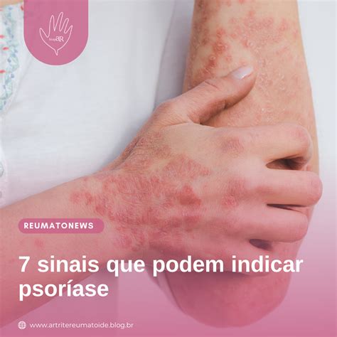 7 Sinais Que Podem Indicar Psoríase Artrite Reumatoide