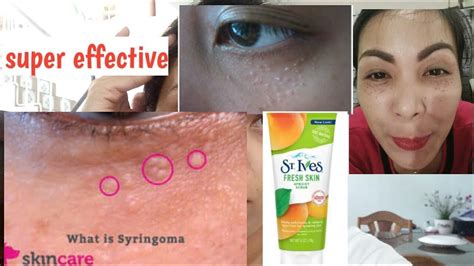 What Is Syringoma And How To Get Rid Of Syringoma St Ives Facial