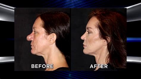 Incredible Nose Transformation The Doctors Youtube