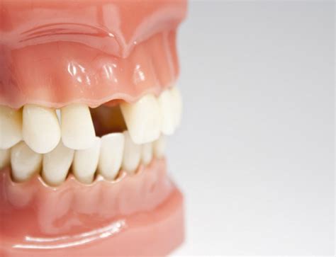 Bump On Your Gums Dental Conditions Dental Arts San Diego