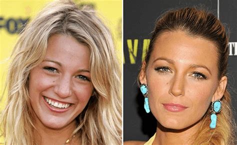 Blake Lively Plastic Surgery Inspiration