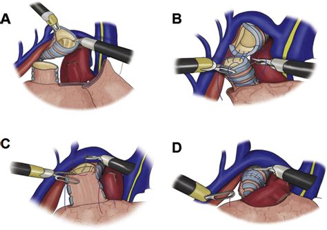 Robotic Bronchial Sleeve Lobectomy For Central Lung Tumors Technique