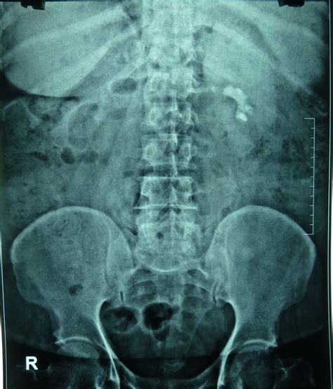 Ramayya Pramila Urology Hospital Partial Staghorn Kidney Stone Removed