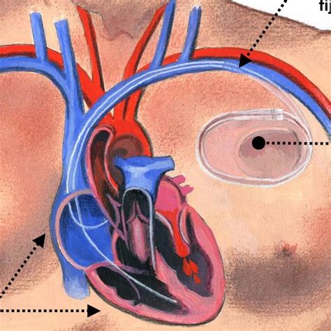 ¿qué Son Y Cómo Funcionan Los Marcapasos Cardiosaudeferrol