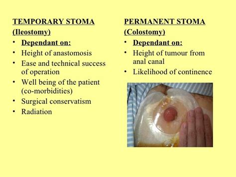 What Are Some Differences Between A Colostomy And An Ileostomy