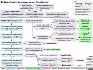 Endometriosis Pathogenesis And Complications Calgary Guide