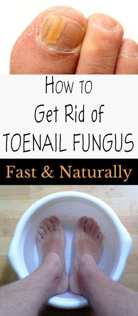 How To Get Rid Of Toenail Fungus Fast And Naturally Toenail Fungus